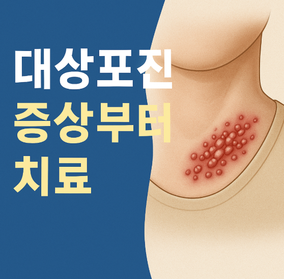 대상포진